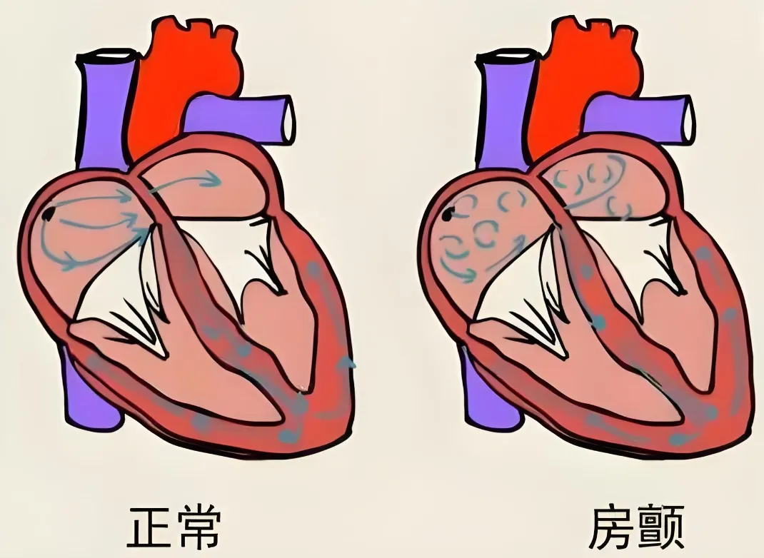 健康生活，房颤为何还会找上门？