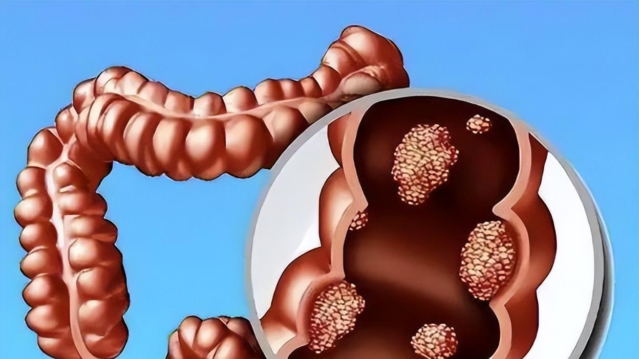 大肠癌正盯上年轻人，7类高危人群做好预防，早期肠镜筛查是关键
