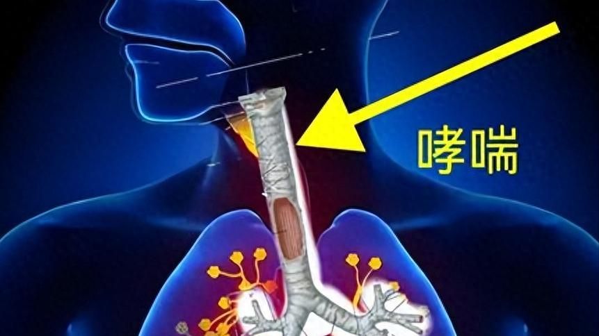 近期哮喘高发期，这些诱因每天都在接触，发作时，记住3步能救命