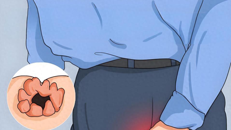 痔疮患病率高达50%以上，出现4类情况立即就医，别让尴尬耽误治疗