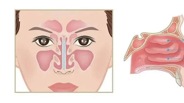 鼻子总不通气？别不当回事！可能是鼻甲肥大在“搞事情”