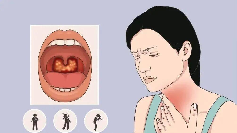 咽喉炎对照这5个症状，中2个以上要警惕！