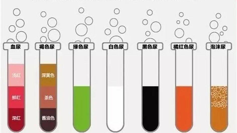 晨起第一泡尿，出现这两种颜色？不是上火，是尿酸结晶在给你的肾脏“投沙”