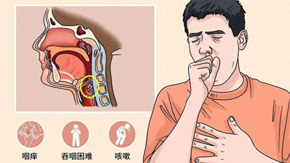 消除咽喉炎症的经典中成药: 补中益气丸，小青龙颗粒，小柴胡颗粒