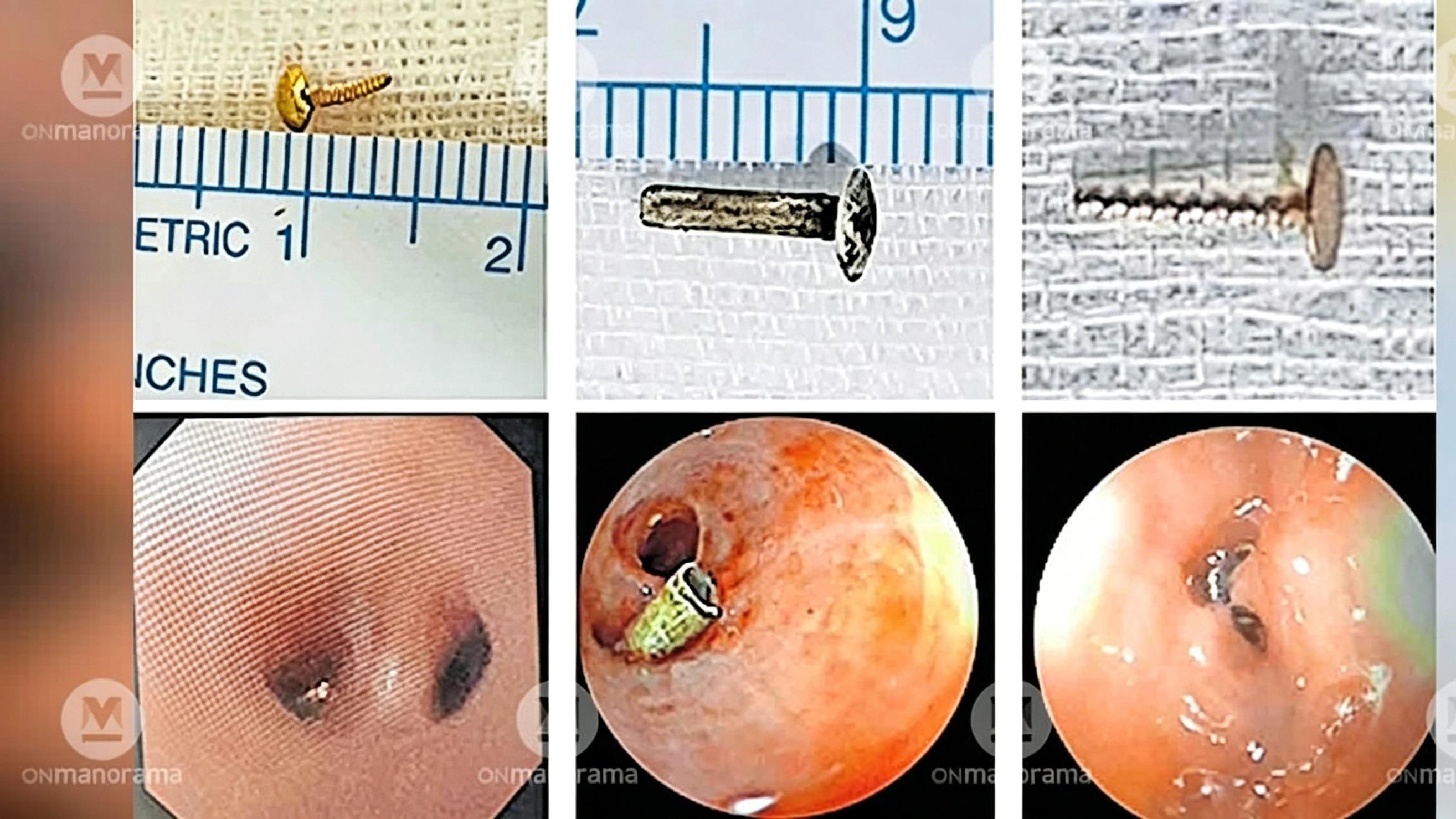 爱美需谨慎！鼻环"旅行"到肺里，距离主动脉仅0.5毫米，险些致命