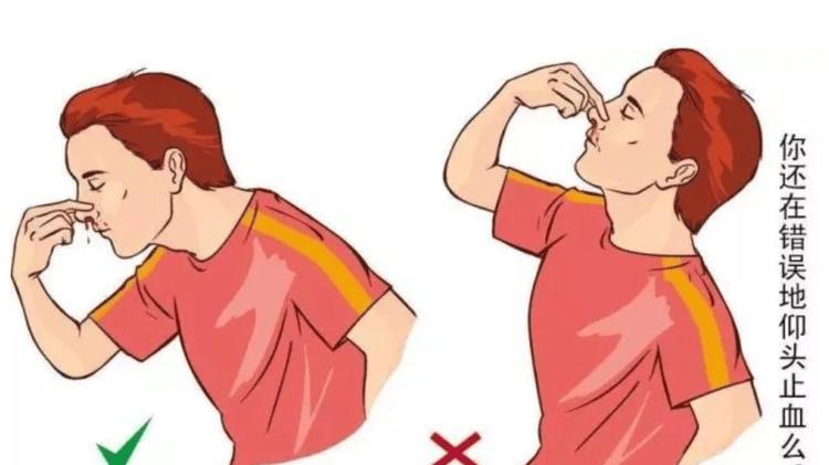 鼻出血别再仰头！正确的止血姿势学起来