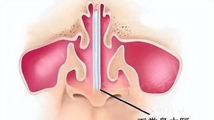 什么是鼻中隔偏曲？鼻中隔偏曲有哪些危害？