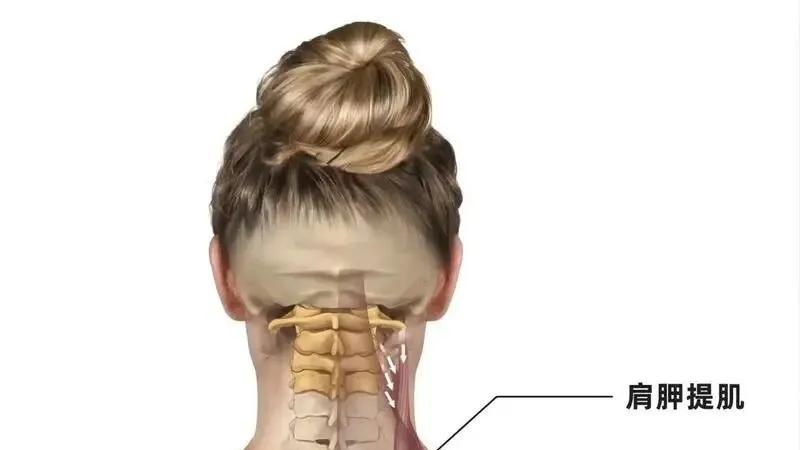 颈肩又酸又僵？别再怪斜方肌，元凶是这块 “过劳肌”