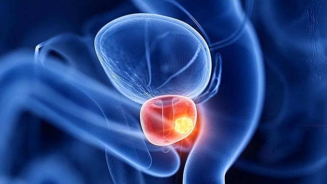 前列腺癌一发现就是晚期？50岁以上男性做好预防，3类症状别忽视