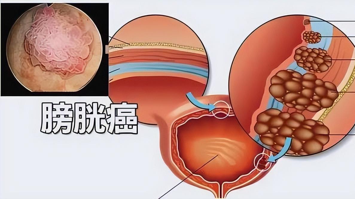 小便带血不痛不痒？不是上火，膀胱癌最会伪装，90%误诊拖成晚期