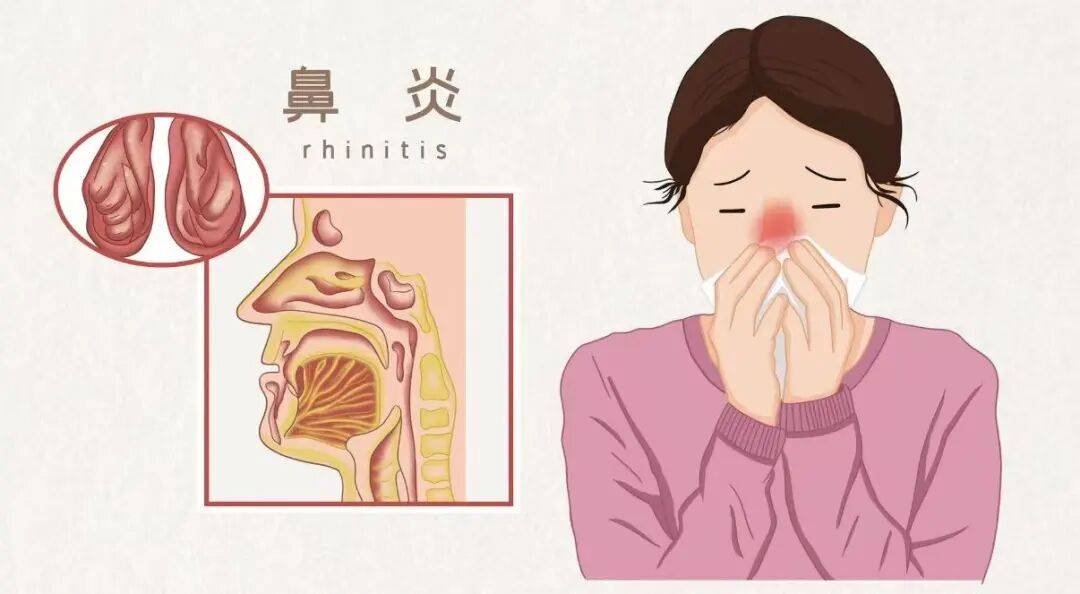过敏性鼻炎总犯？教你几招，避免拖成哮喘