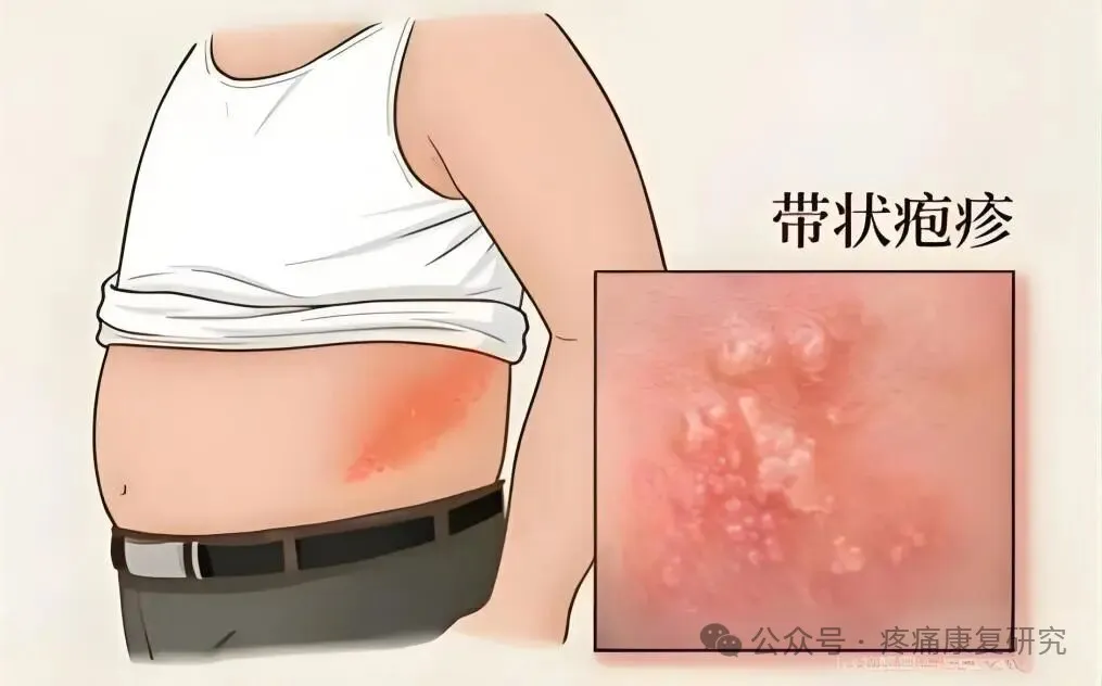 《中国带状疱疹相关性疼痛全程管理指南》2025版