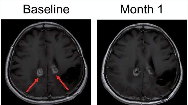 溶瘤病毒是“万能神药”吗？肝癌、膀胱癌、脑瘤都有效？这个“以毒攻毒”的概念为晚期患者按下“暂停键”