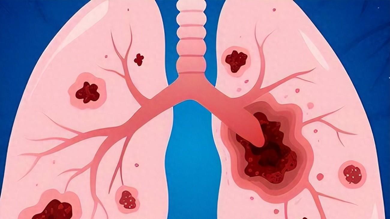 肺栓塞早期不痛不痒，早干预，治愈率超90%，出现3类症状及时就医