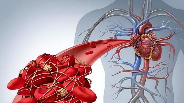 胸痛胸闷心慌？小心心血管病，早期80%是可以预防，突发时做好4点