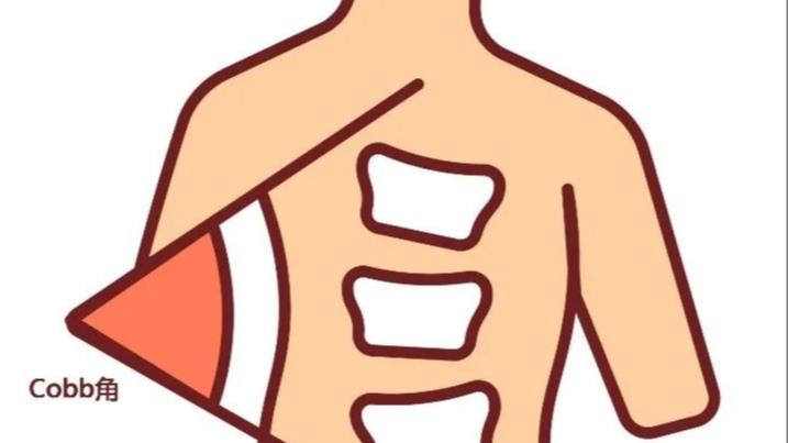脊柱侧弯多少度是怎么定的？不是拿尺子一量那么简单