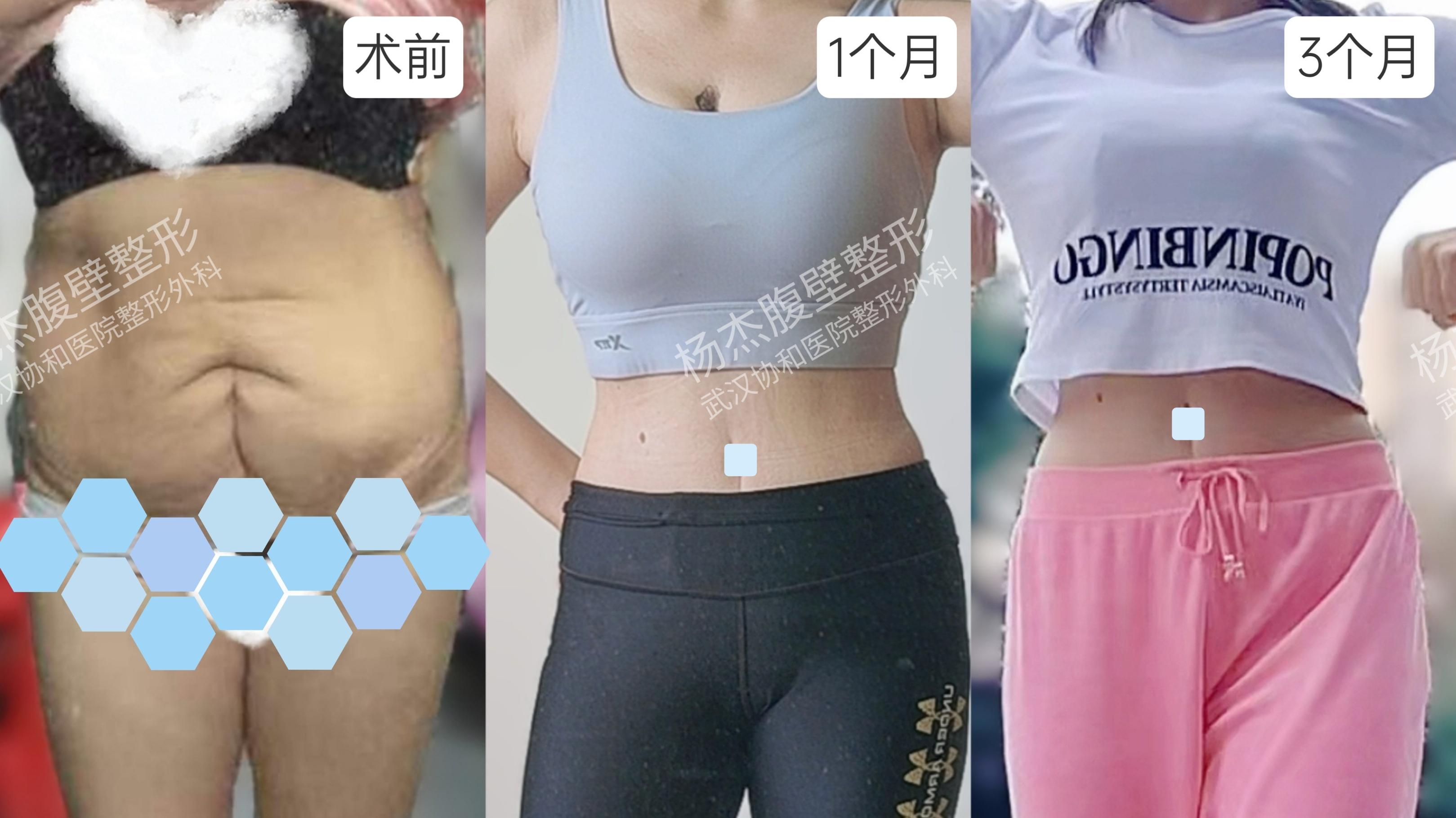 产后妈妈想“甩掉”大肚腩，不容易...