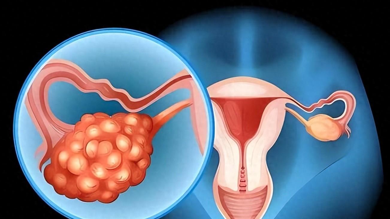 卵巢癌70%确诊已是晚期，正在盯上30+女性，出现7类信号别忽视