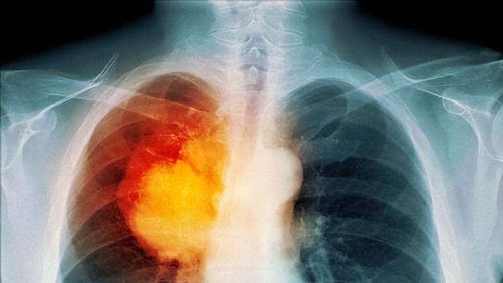 肺癌不是吸烟者专利，这3类人群也容易患病，早期治疗生存率超80%
