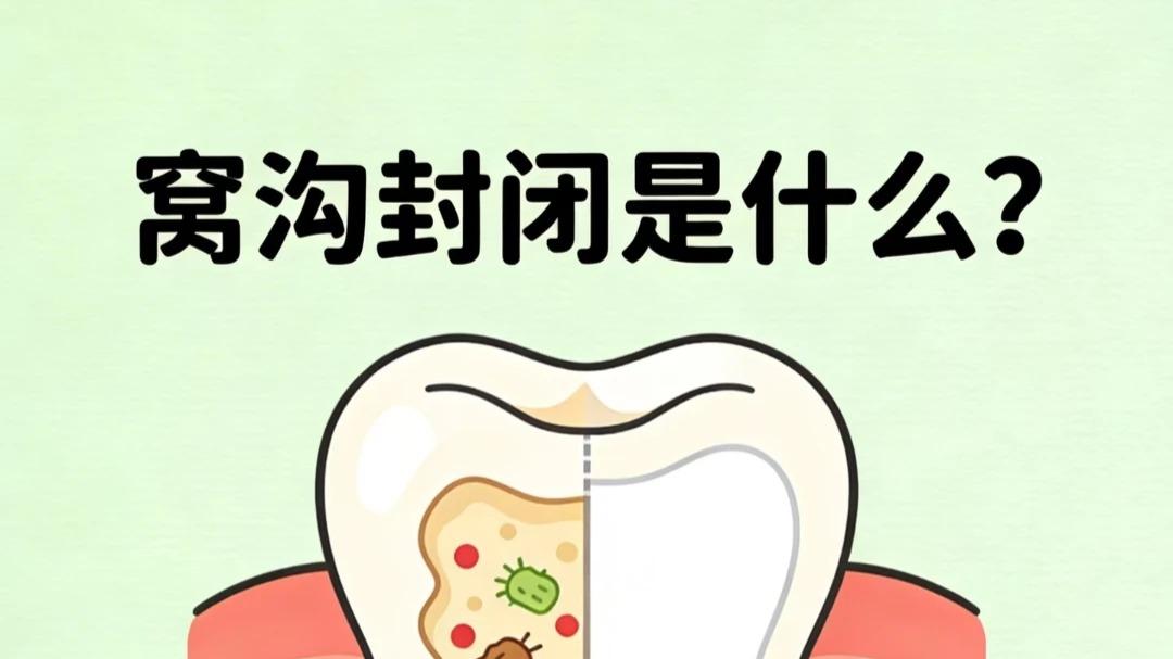 六龄齿必护！窝沟封闭 + 涂氟，守护孩子终身恒牙