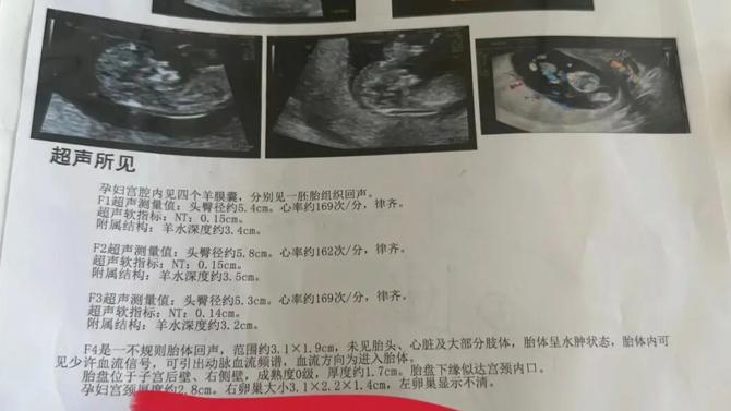 辽宁孕妇产检像拆盲盒！两月内从1胎变4胎，概率比中头奖还低