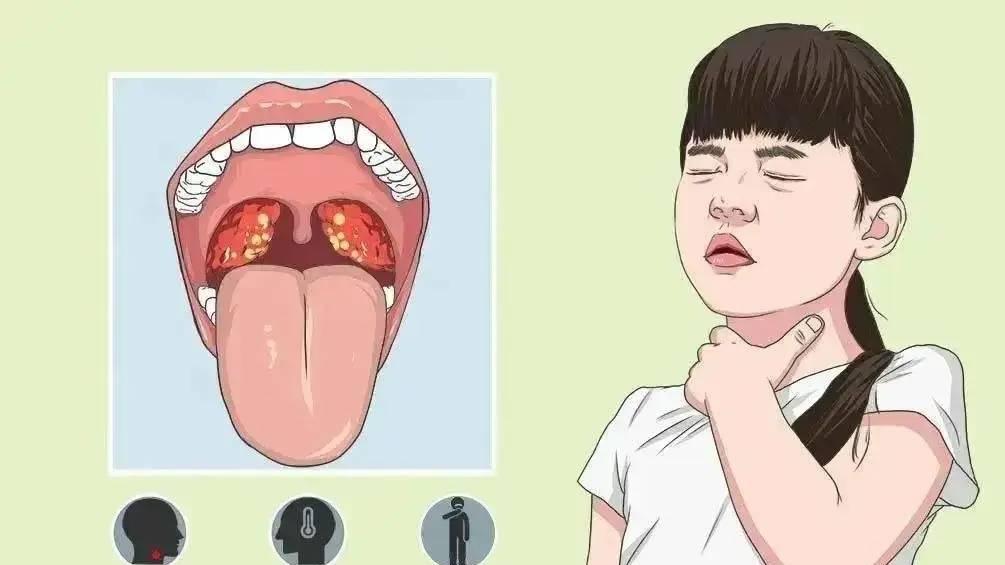 扁桃体炎大揭秘：别让 “小扁桃体” 惹出大麻烦！