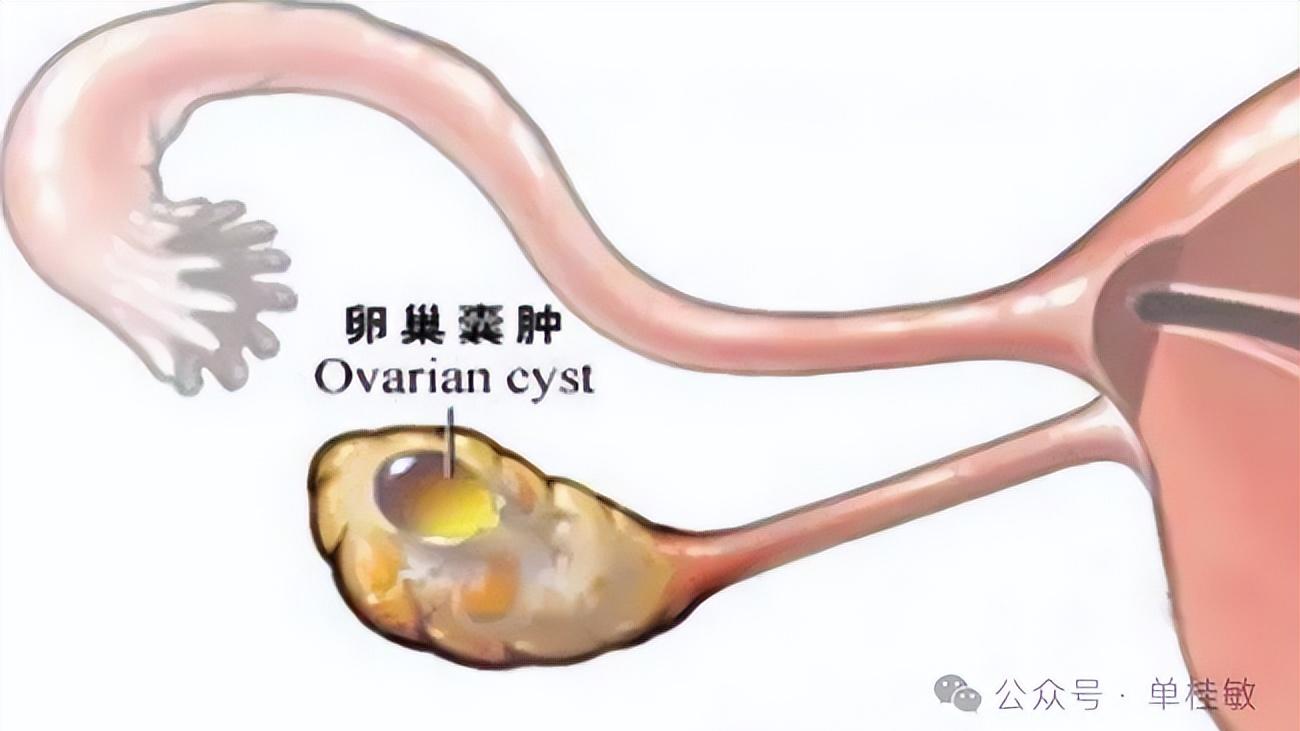 肠癌五年转移肺部和卵巢艾灸消除