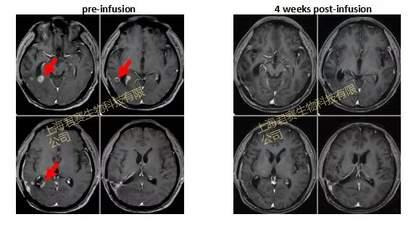 客观缓解率50%，持续缓解超5年！国内新一代TIL疗法进展迅速，黑色素瘤、肺癌、胰腺癌等患者能否获益