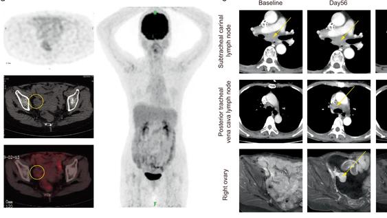 总生存率100%！癌症疫苗的时代真的来了，胰腺癌、食管癌数据惊艳，古巴肺癌疫苗、mRNA疫苗...纷