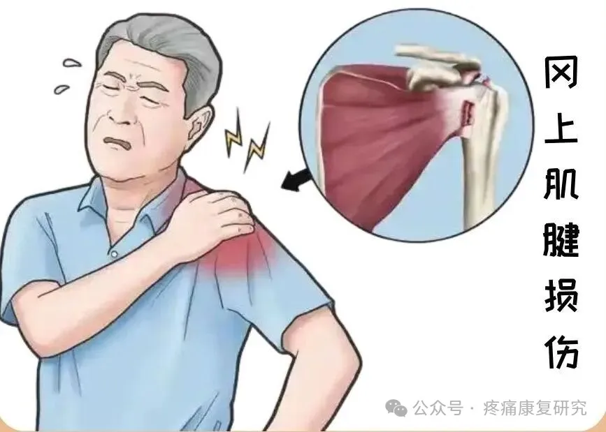 肩痛不止肩袖损伤！6 类 “隐藏病因”全解析