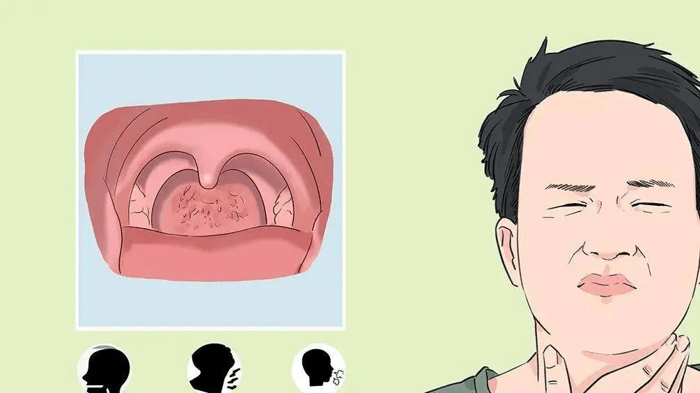 嗓子异物感强烈，咽喉炎在“潜伏”？别忽视！