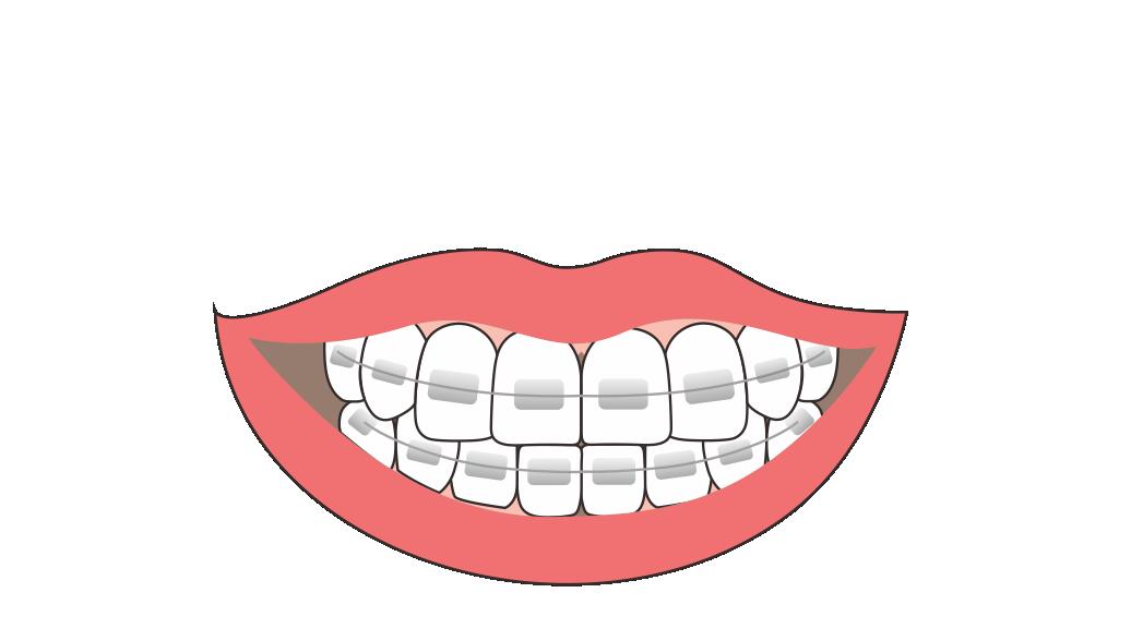 成年人牙齿矫正，到底是“及时止损”还是“自找麻烦”？