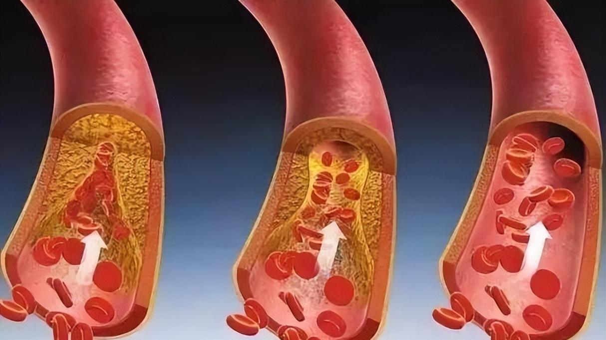 人未老，血管先衰？别让血管年龄拖垮你的身体，10个信号别忽视