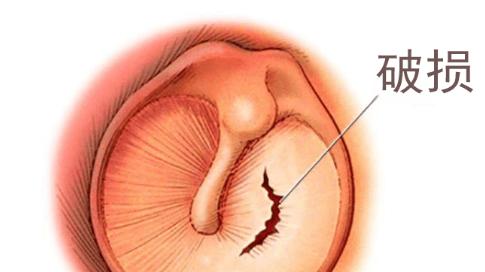 耳膜破了耳朵会聋吗？鼓膜穿孔后要及时正确处理！