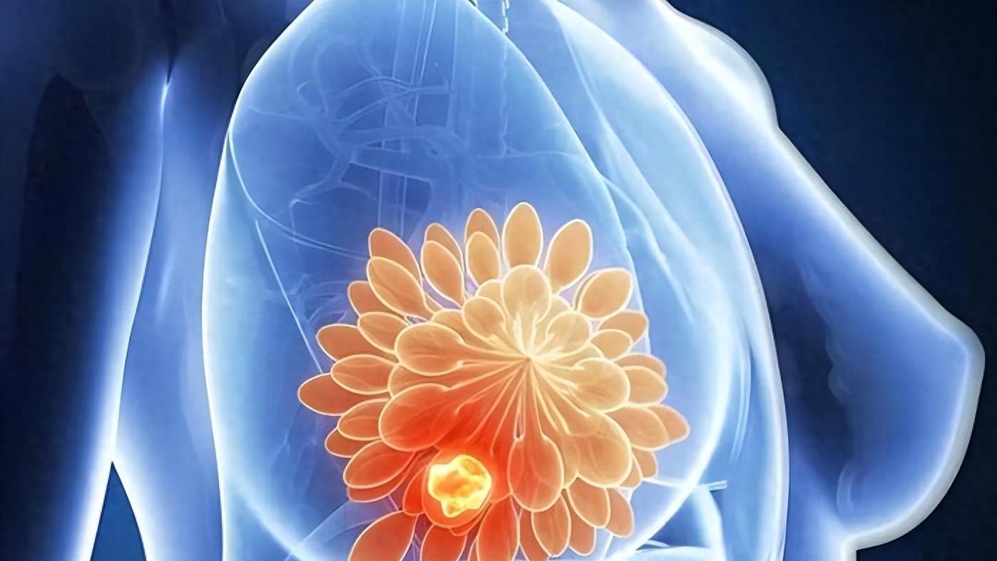 35岁以下乳腺癌患者越来越多，早期治疗，5年生存率可超过90%