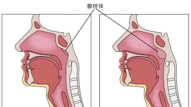 孩子腺样体到底该不该切？专家：遇到这几种情况果断切！