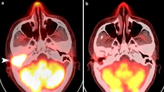 刚刚！海南博鳌传来喜讯：国内首例硼中子俘获治疗（BNCT）临床应用成功，35分钟搞定晚期舌癌