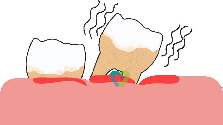 牙齿松动不是突然来的，这4个习惯正在加速它脱落，快自查