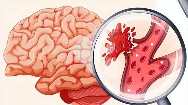 突然说话不利索？几分钟就好了？别高兴太早，这是大脑在求救