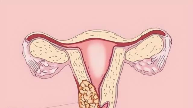 早期宫颈癌几乎毫无症状，做好预防是关键，疫苗+筛查=双保险