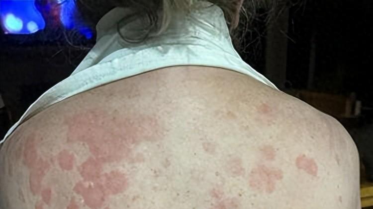 这可能是最奇怪的蜱虫叮咬后遗症！被咬后人不能吃畜肉，不然就有生命危险