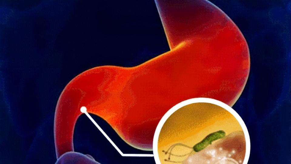 胃里悄悄长出“小疙瘩”，别紧张，胃息肉没有你想象中可怕