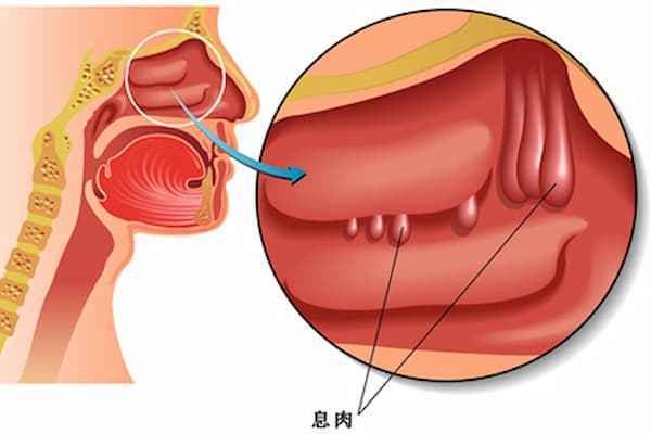 鼻息肉切除担心复发，不切又堵塞难忍，如何是好？