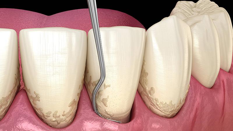 别等牙疼才去医院，春节后这件事越早做越好