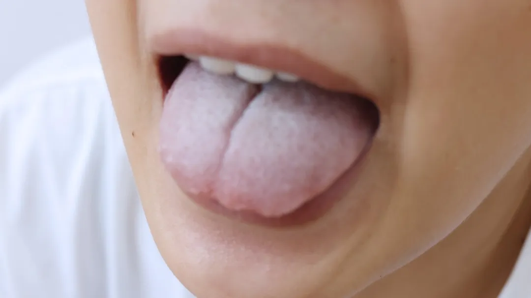 体内有病，舌头告知？舌象出现这些表现，警惕是否疾病“来袭”了