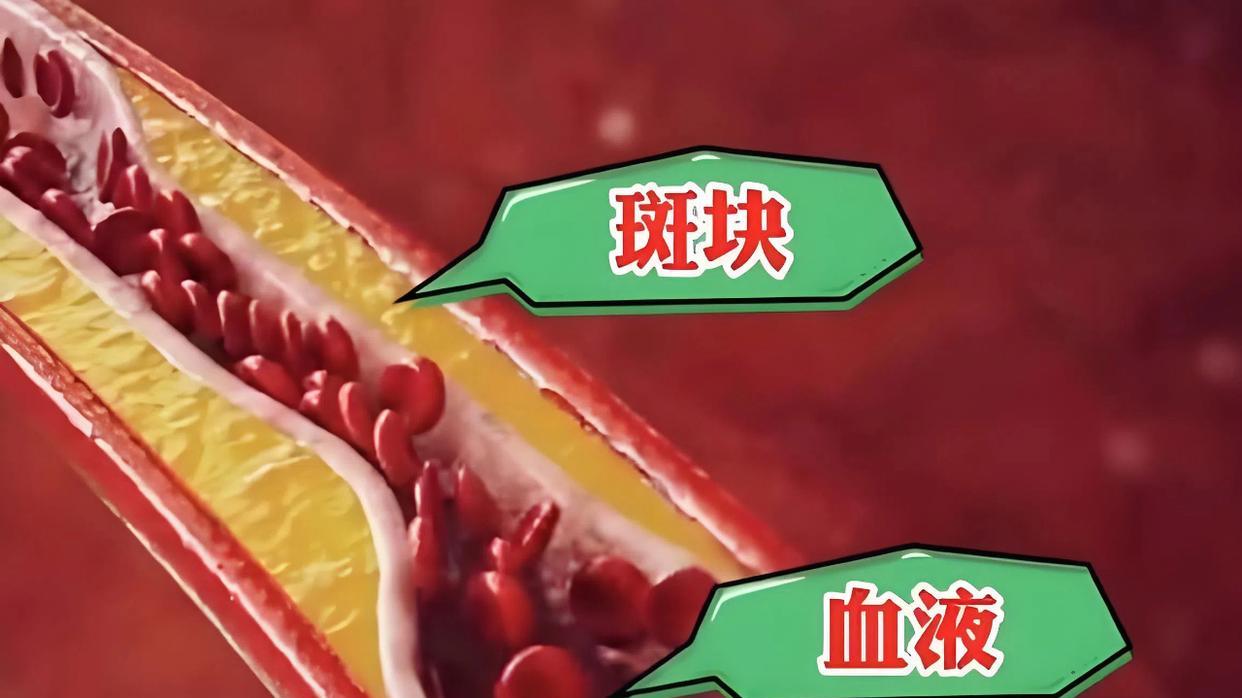 体检单上冒出“颈动脉斑块”？别自己吓自己