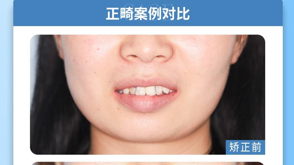 牙齿畸形的原因是什么？—义乌牙齿矫正