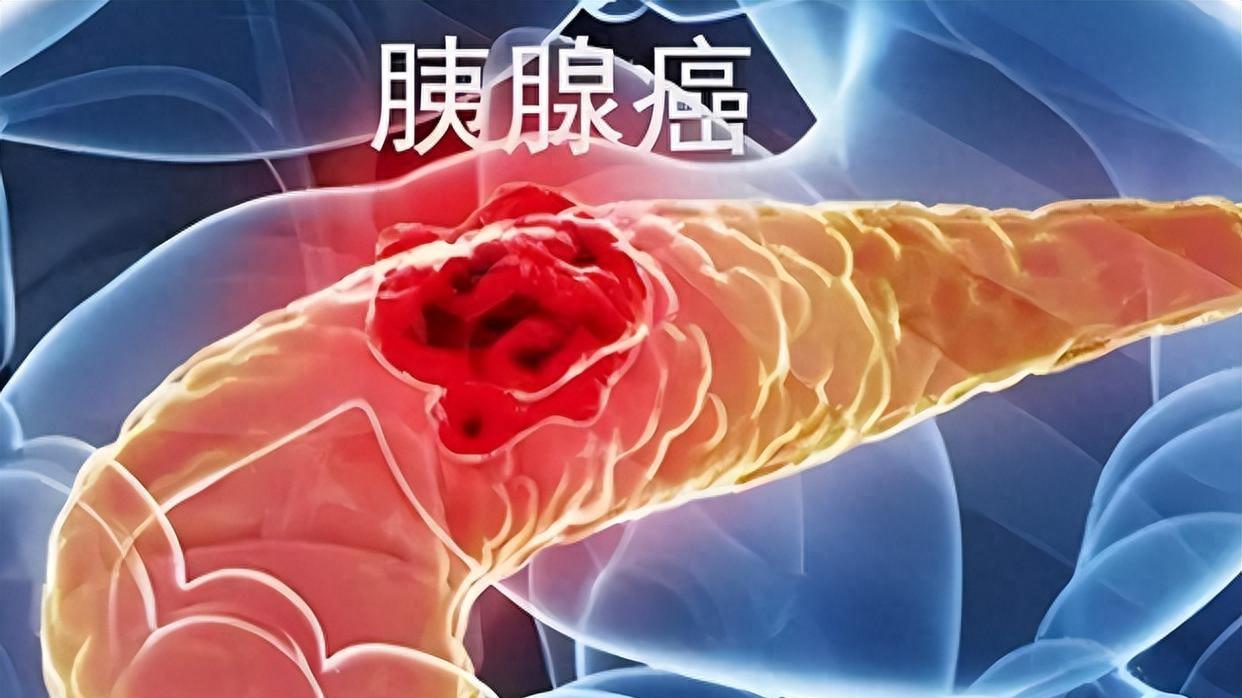 80%胰腺癌患者确诊时是晚期，出现黄疸、消瘦、腹痛，请及时就医