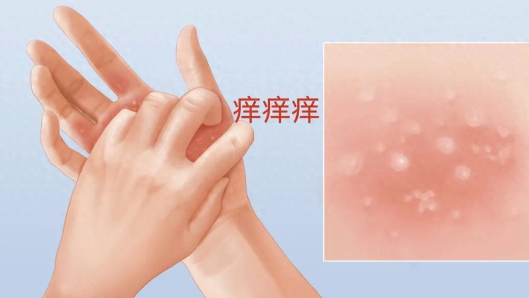 汗疱疹反复发作怎么办？用药+护理
