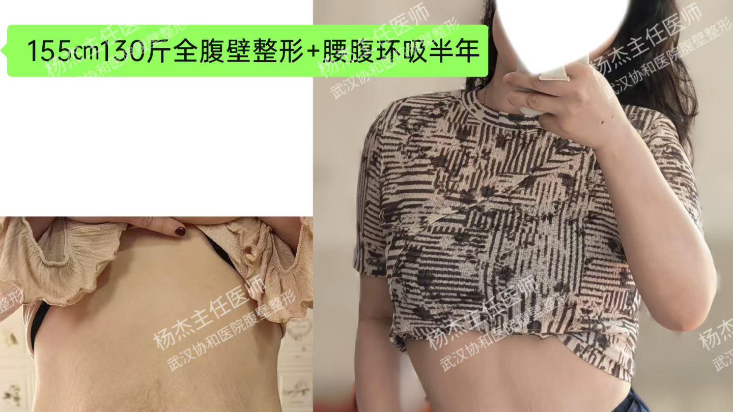 DFS腹壁成形术，不仅是体形修复，更是体重管理的“最后一公里”